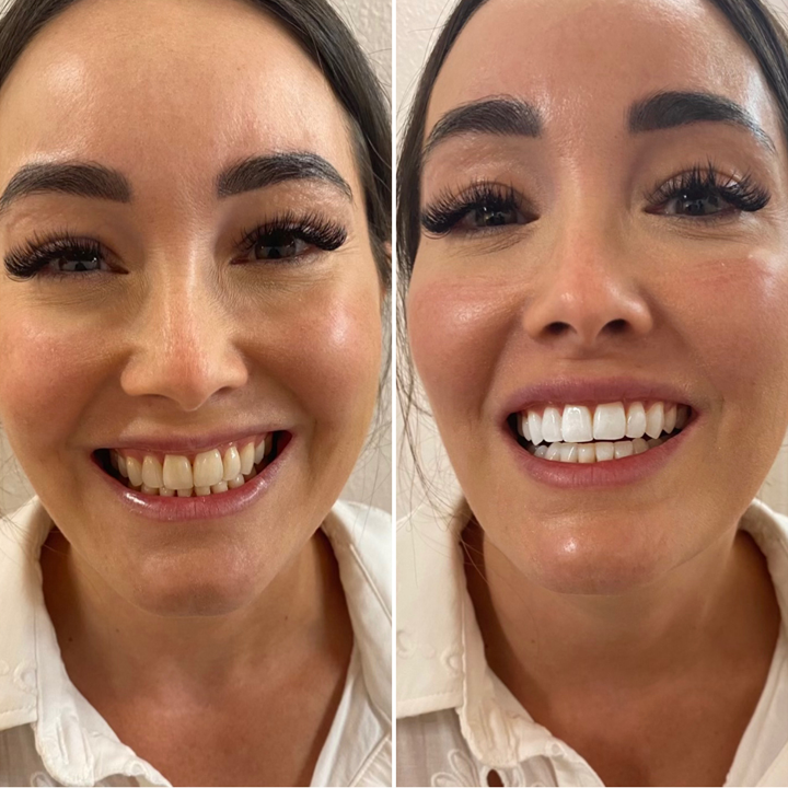 Lápiz Blanqueador Dientes Instantáneo (Compra 1 lleva 2  + Regalo Exclusivo 🎁)